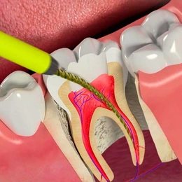 Лечение корневых каналов - Сүрөт 1