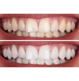 Профессиональная чистка зубов - Сүрөт 2