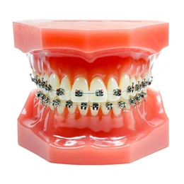 Установка стандартной брекет-системы - Сүрөт 1