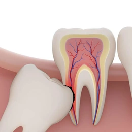 Удаление зуба мудрости - Сүрөт 1