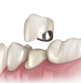 Установка металлокерамической коронки - Сүрөт 1