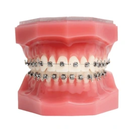 Установка саморегулирующейся брекет-системы - Сүрөт 1