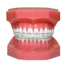 Установка керамической брекет-системы - Сүрөт 1